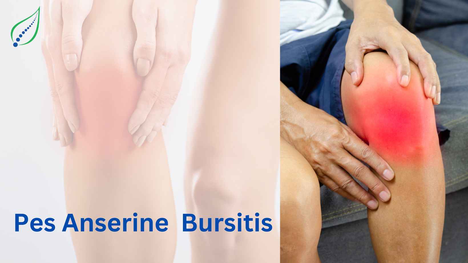 Pes Anserine (Knee Tendon) Bursitis